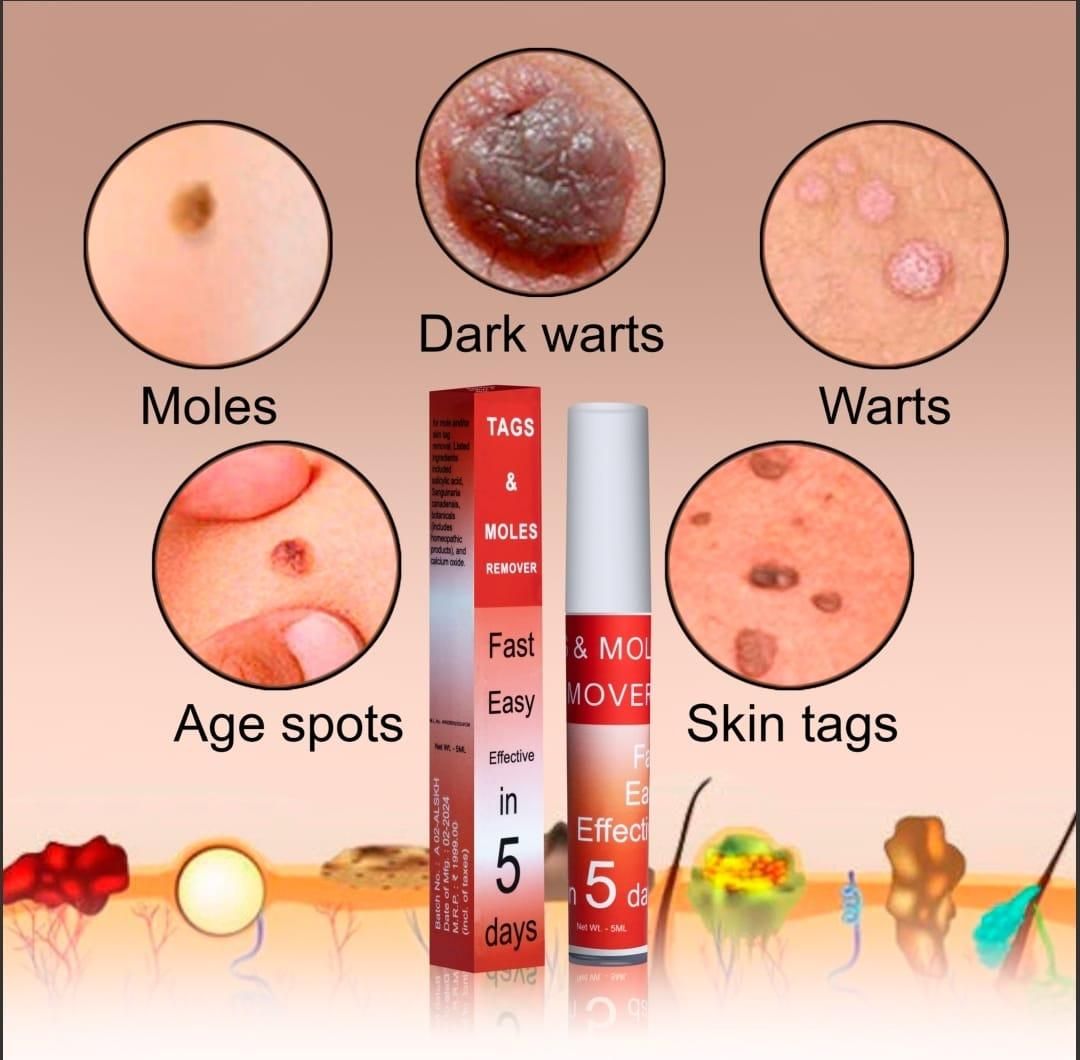 WipeOff Tags & Mole Remover (BUY 1 GET 1 FREE)